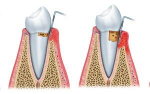 Clínica Dental Manuel Marín - Enfermedad Gingival