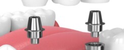 Clínica Dental Manuel Marín - Implantología